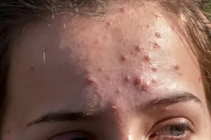 Penyebab Jerawatan Di T-Zone Bukan Karena Lagi Kasmaran